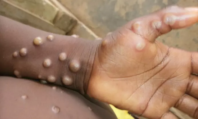 No urgent need for mass monkeypox vaccinations, says WHO