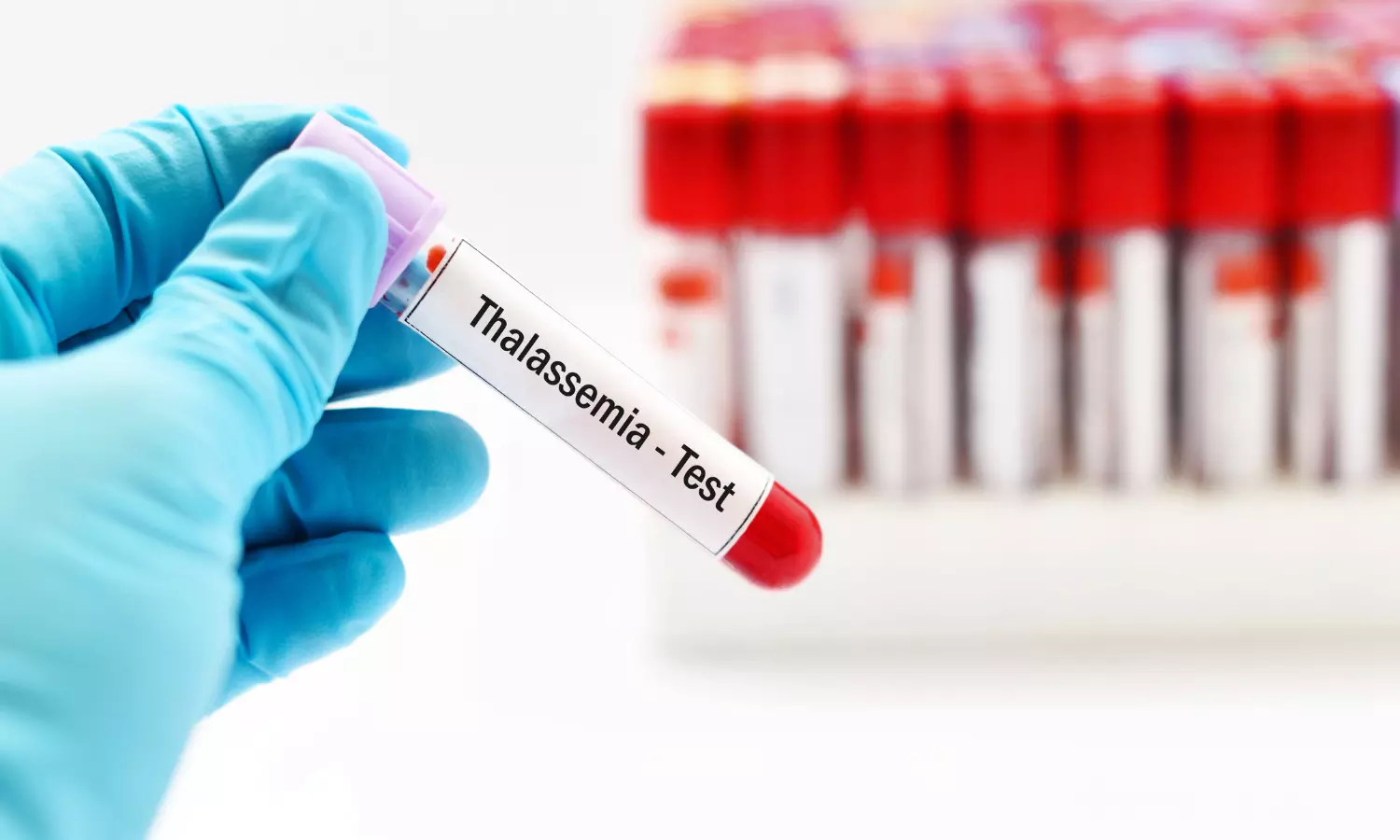 थैलेसीमिया पर रोक के लिए ज़रूरी है खून की जाँच के दिशा-निर्देशों का भी कड़ाई से पालन हो