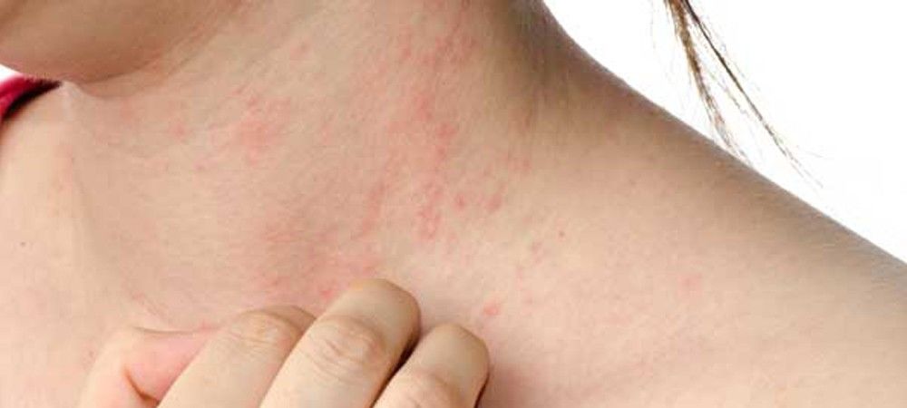 त्वचा की एलर्जी से बचने के लिए कैमिकल्स से रहें दूर