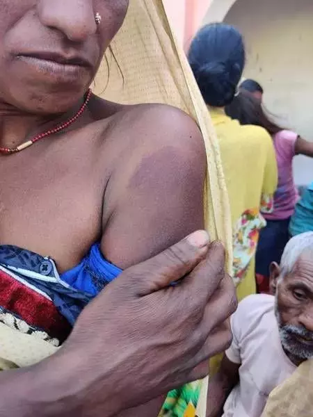 रजंती देवी के हाथ में अभी भी दर्द है।