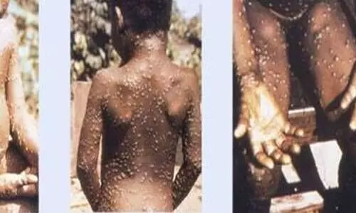monkeypox