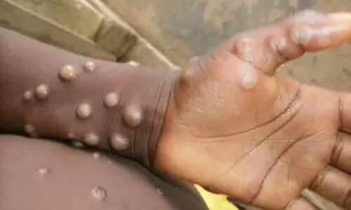 monkey pox